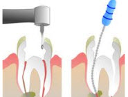 root canal